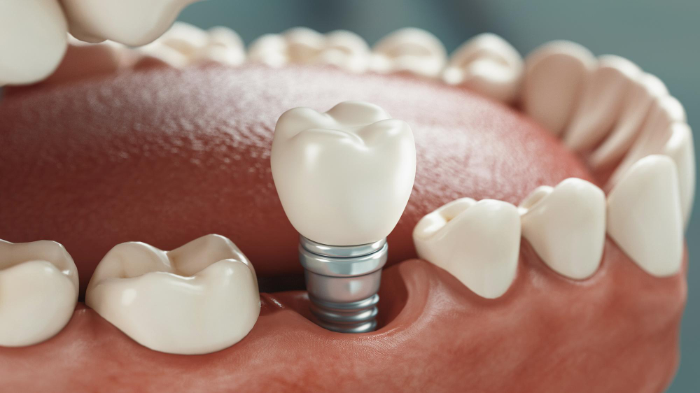 Dental Implants Green Valley, AZ